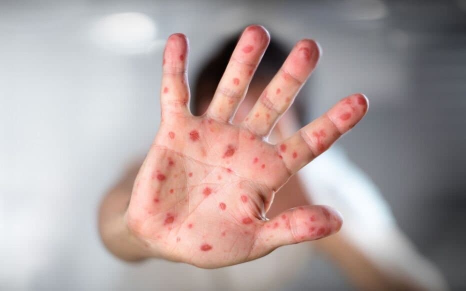 Rougeole : L'Épidémie Silencieuse Qui Frappe de Plein Fouet l'Europe