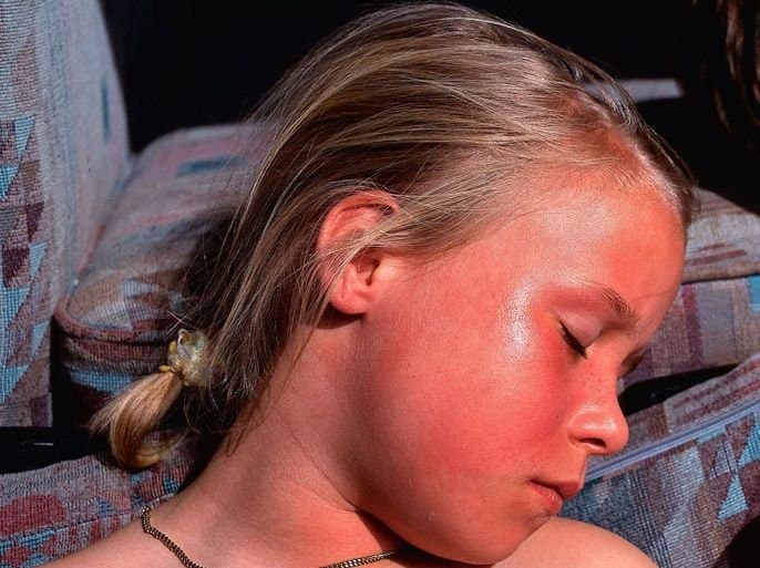Coups de soleil.. Quand faut-il consulter un médecin ?