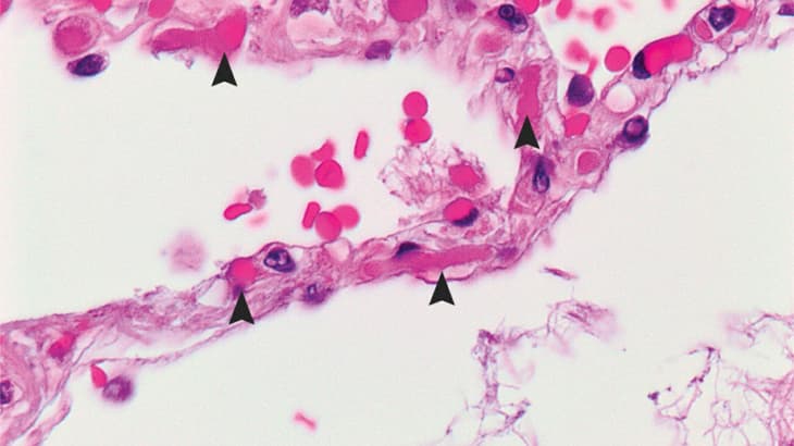 Développer des robots hybrides biologiques pour le traitement du cancer
