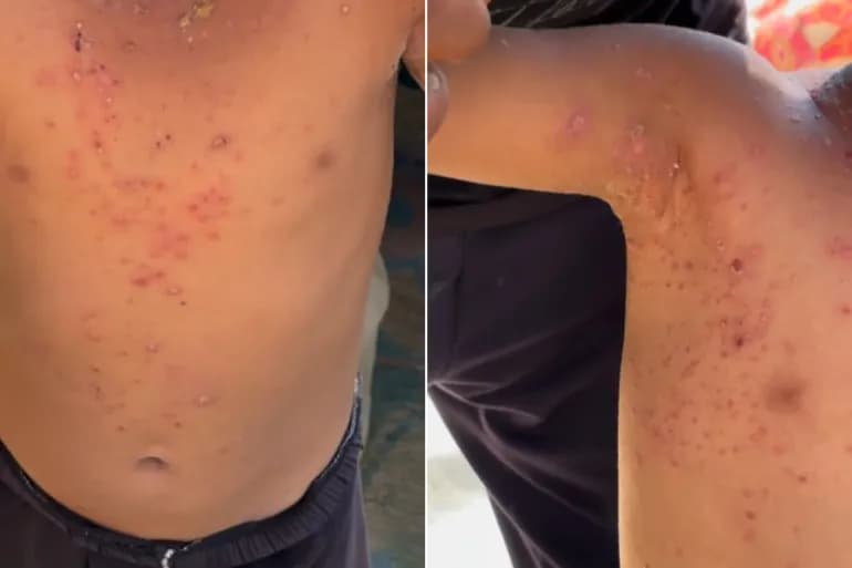 Les maladies de peau ravagent les corps des enfants de Gaza