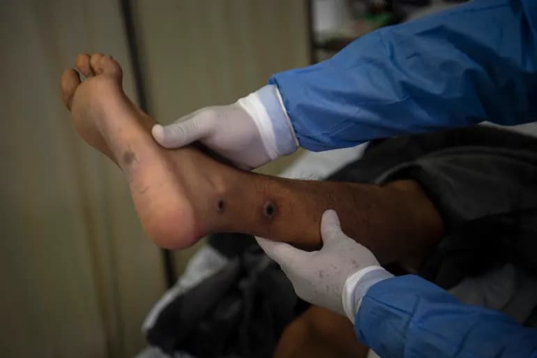 Une nouvelle souche plus dangereuse. La Santé mondiale tire la sonnette d'alarme sur la variole du singe