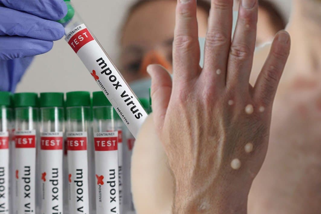 Efficacité des vaccins face au nouveau variant du mpox : quelles perspectives ?