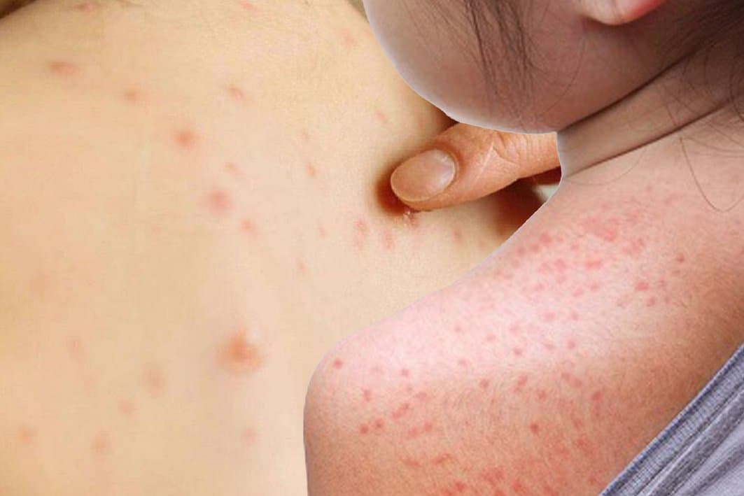 Maroc: Appel urgent à une vaccination contre la rougeole "Bouhemroun"