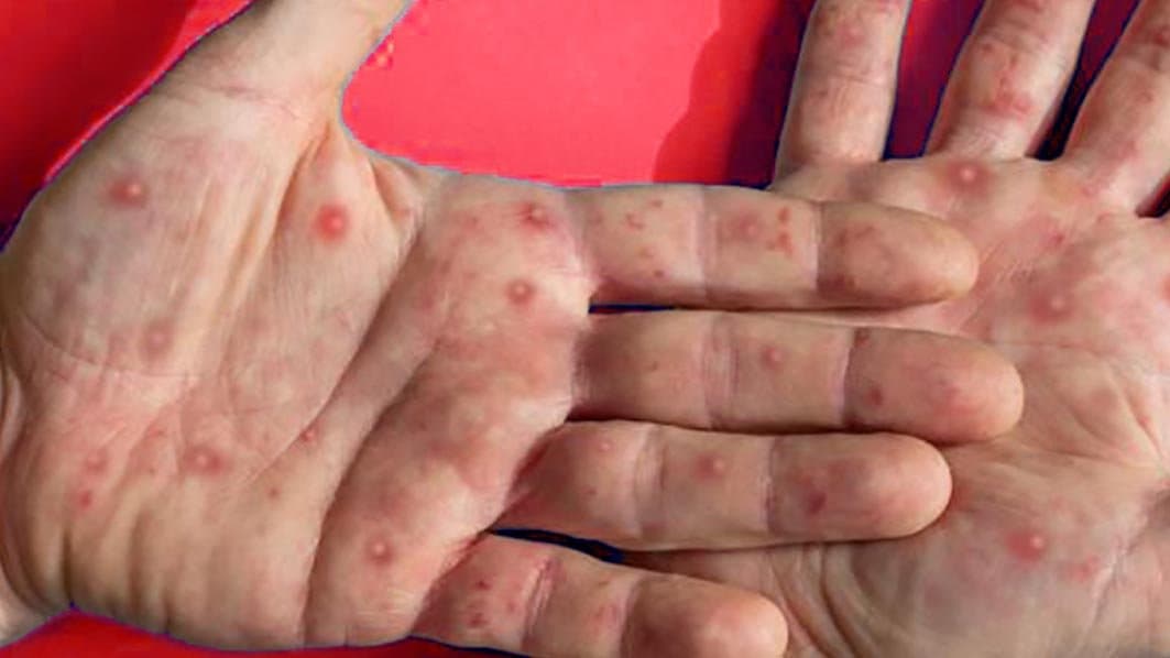 Variole du singe: L'OMS maintient son plus haut niveau d'alerte