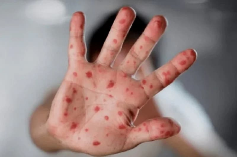 Propagation de l'épidémie de rougeole dans plusieurs États américains