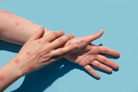L'Europe relève son niveau d'alerte face à l'épidémie de variole du singe